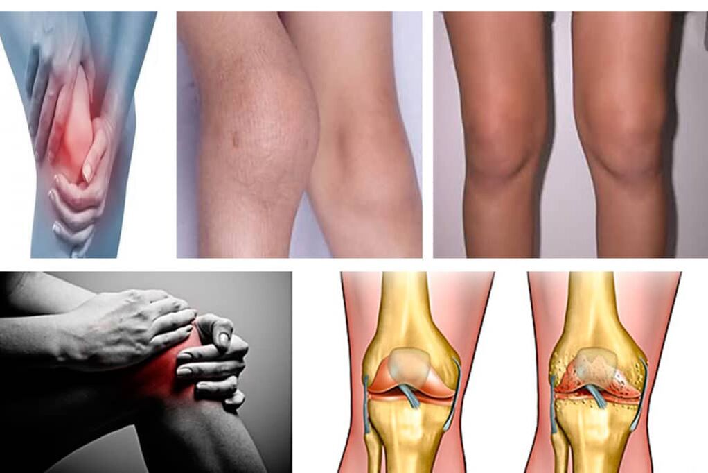 Knee osteoarthritis symptoms
